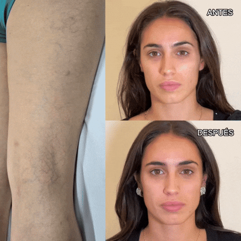 🟣 VARICE Stop ✨2X1✨– Cápsulas Naturales para Corregir y Prevenir las Várices y el envejecimiento prematuro!!! ✨2X1✨