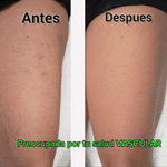 🟣 VARICE Stop ✨2X1✨– Cápsulas Naturales para Corregir y Prevenir las Várices y el envejecimiento prematuro!!! ✨2X1✨