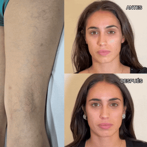 🟣 VARICE Stop ✨2X1✨– Cápsulas Naturales para Corregir y Prevenir las Várices y el envejecimiento prematuro!!! ✨2X1✨